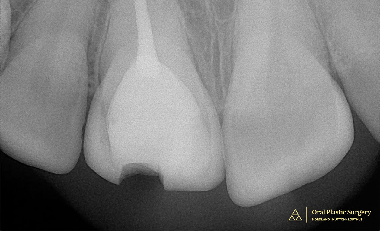 Showing a large filling and minimal natural structure, making the tooth non-restorable