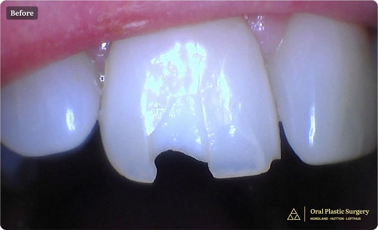 Tooth #8 shows a visible fracture, indicating structural compromise and the need for further evaluation and treatment