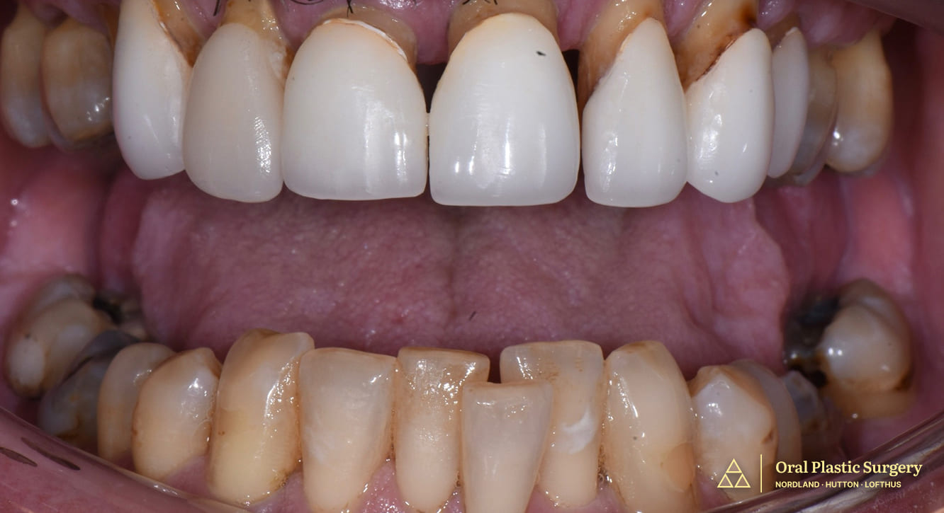A full smile transformation- loose, painful teeth were removed and replaced with a stable, implant-supported restoration