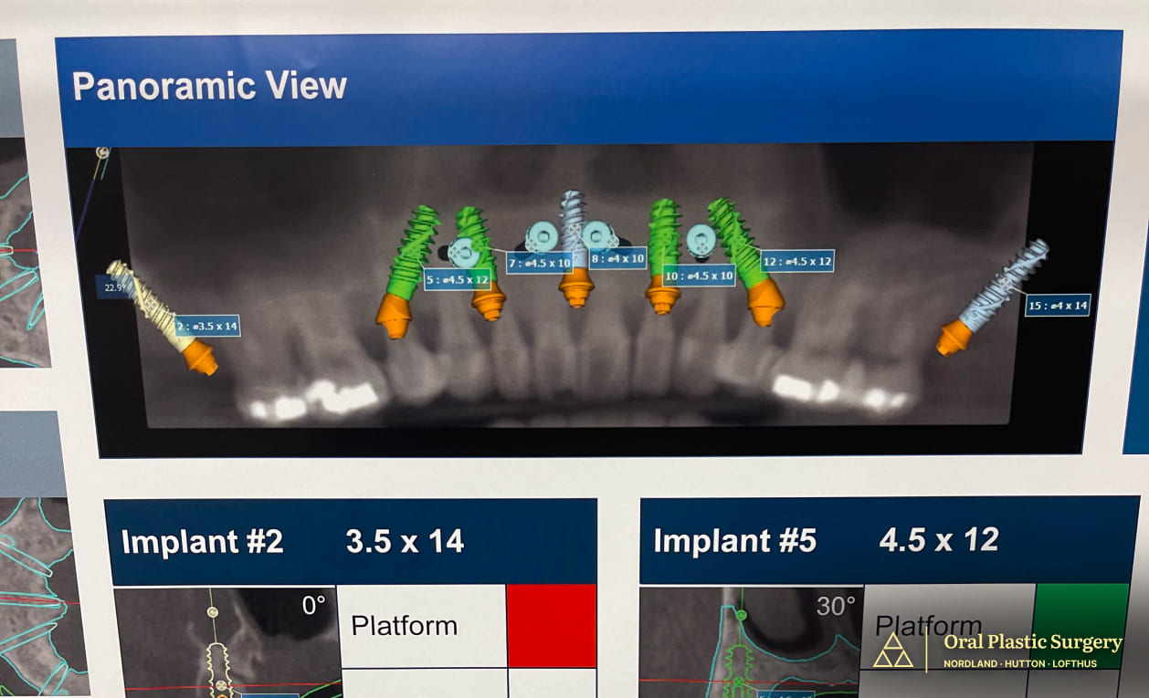Digital planning technology mapped out the precise placement of Phil’s seven implants, including two pterygoid implants for added stability