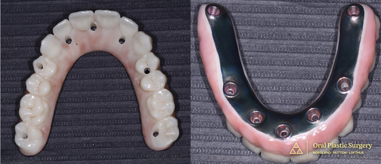 Phil’s new smile foundation- a custom-designed full arch prosthesis and underside with titanium framework, engineered for comfort, strength, and lasting peace of mind