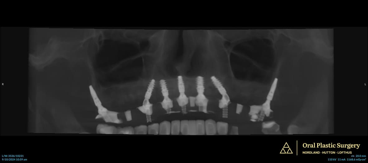 Post-surgery X-ray shows all seven implants in place. The pterygoid implants provide secure anchorage in the upper jaw, allowing Phil to regain molars and full chewing strength