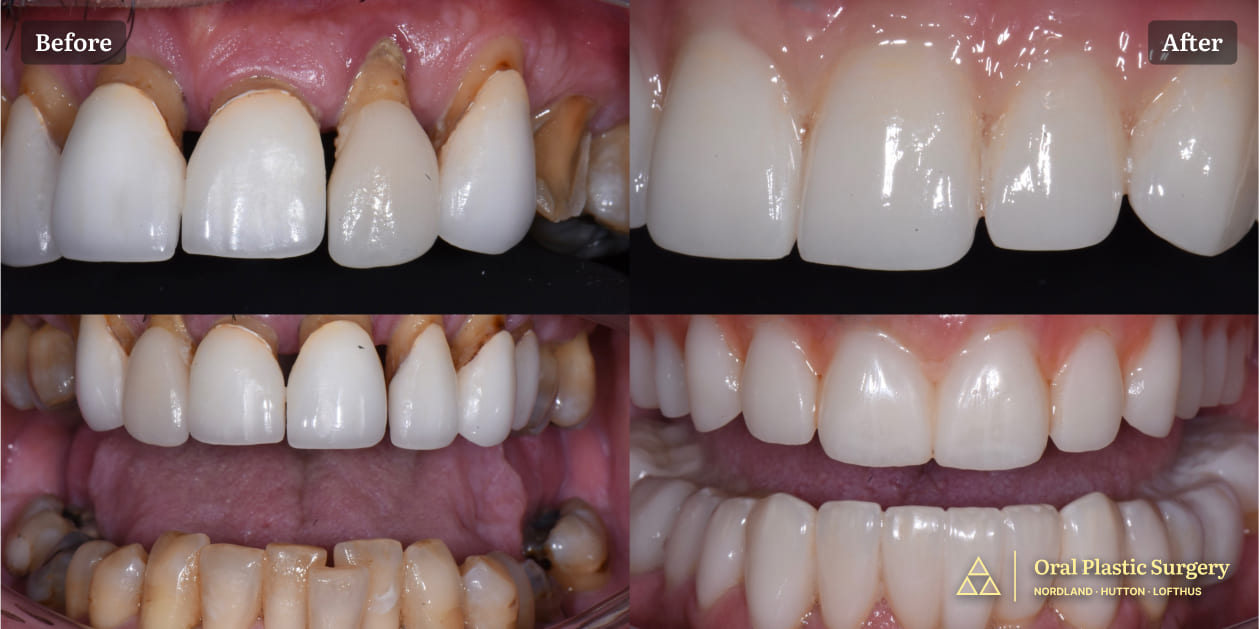 Restoring Health, Comfort, and Aesthetics by Eliminating Diseased Teeth Before After 4 Pictures