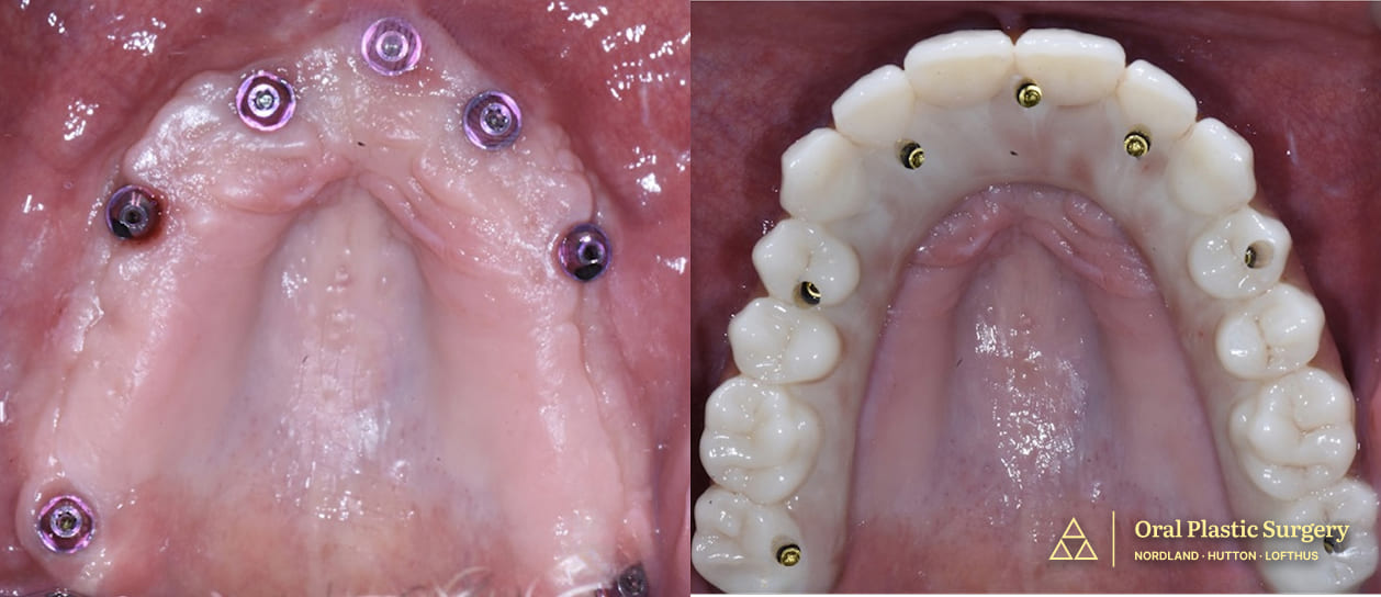 Surgical view- seven implants, including two pterygoid implants, were placed for maximum stability and function. Precise implant placement improved chewing strength and long-term durability